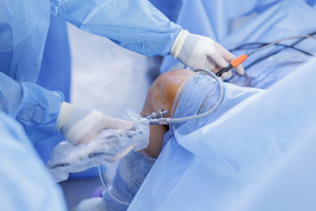 Arthroscopic ACL Reconstruction